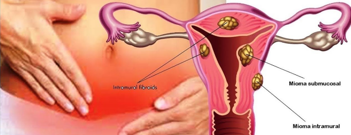 Homeopathy Treatment For Fibroid Tumours
