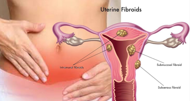 Homeopathy Treatment For Uterine Fibroid